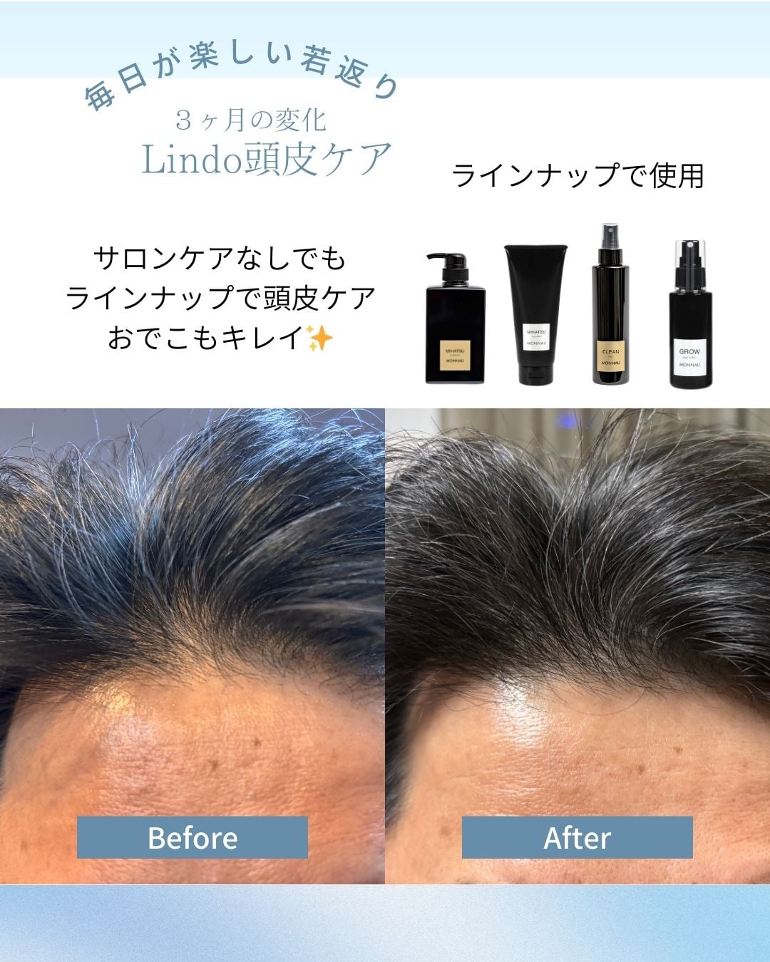 ホームケア3ヶ月の生え際の変化とケア用品ラインナップ