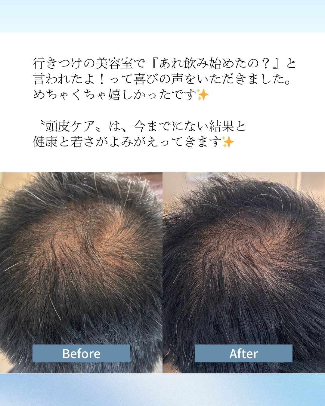 頭皮ケアを続けたお客様のつむじ周りのビフォーアフター